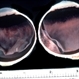 Tumor causing retinal detachment Tumor causing retinal detachment